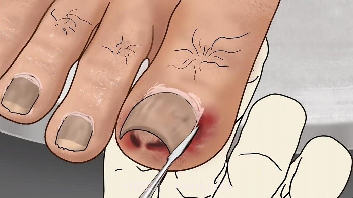 修脚足疔模拟器去更新版v1.0截图