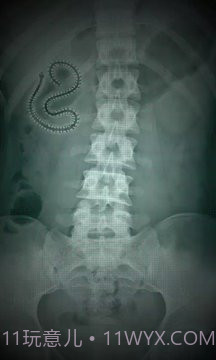 X射线扫描器胃截图1 X射线扫描器胃截图1