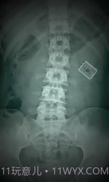 X射线扫描器胃截图3 X射线扫描器胃截图3