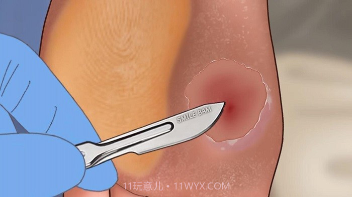 修脚足疔模拟器高画质版截图3